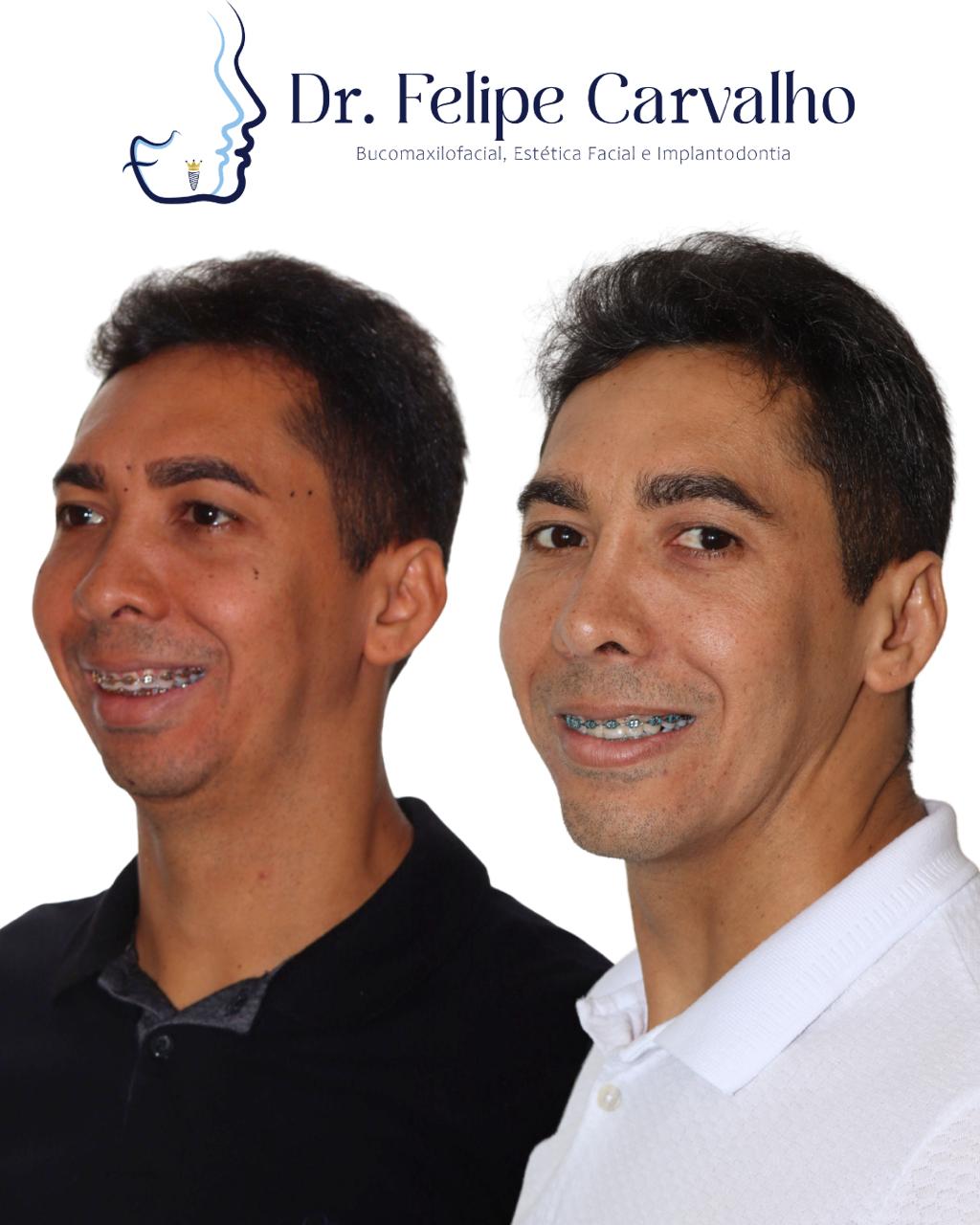 Caso real — Dr. Felipe Carvalho