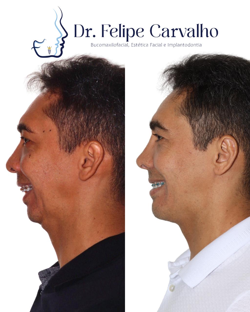Caso real — Dr. Felipe Carvalho