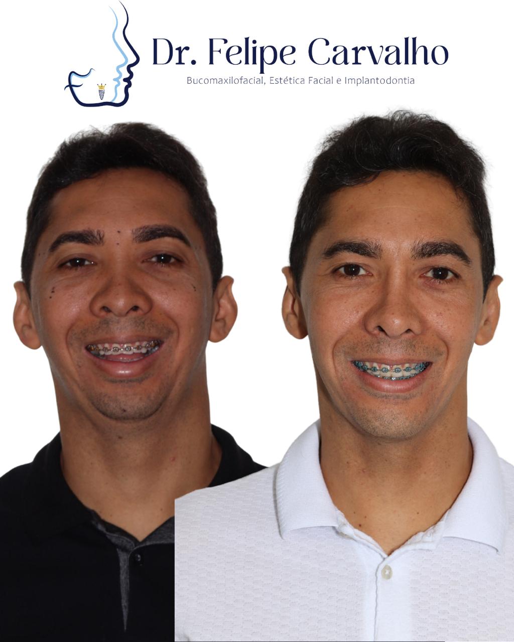 Caso real — Dr. Felipe Carvalho