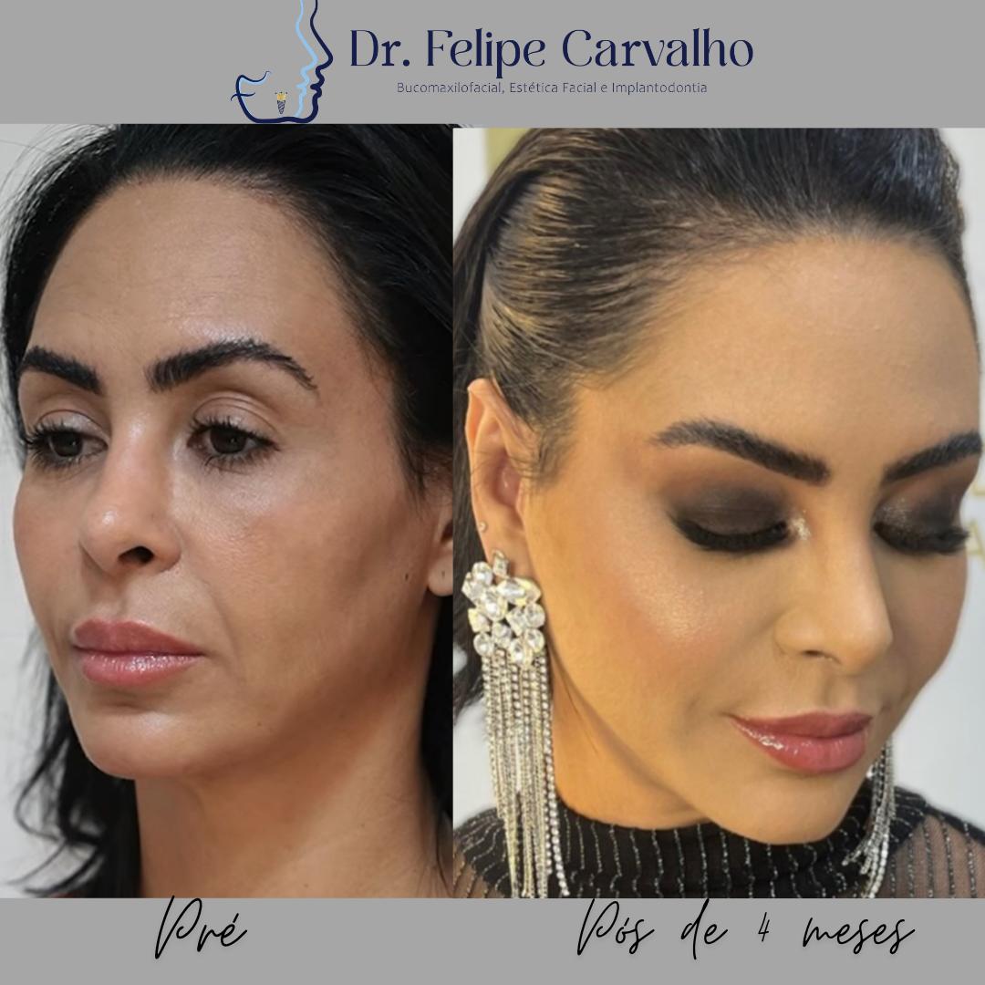 Caso real — Dr. Felipe Carvalho
