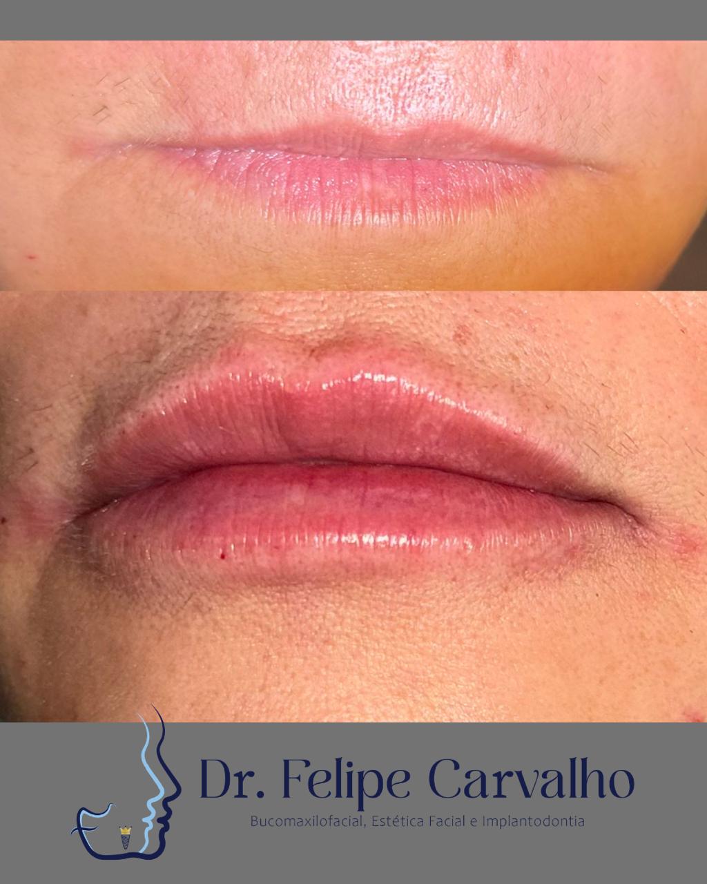 Caso real — Dr. Felipe Carvalho
