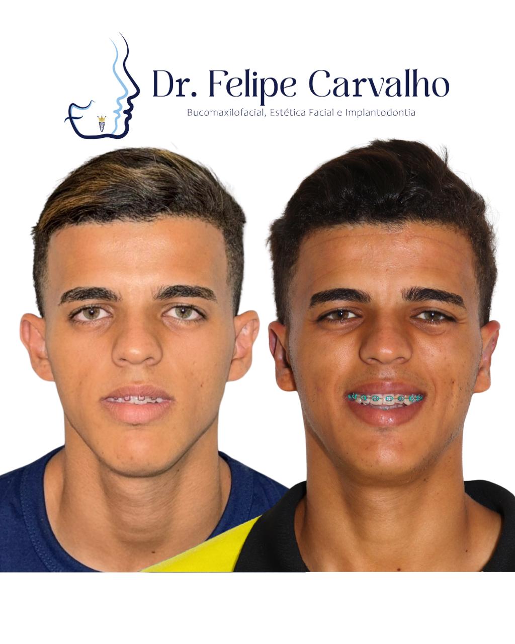 Caso real — Dr. Felipe Carvalho