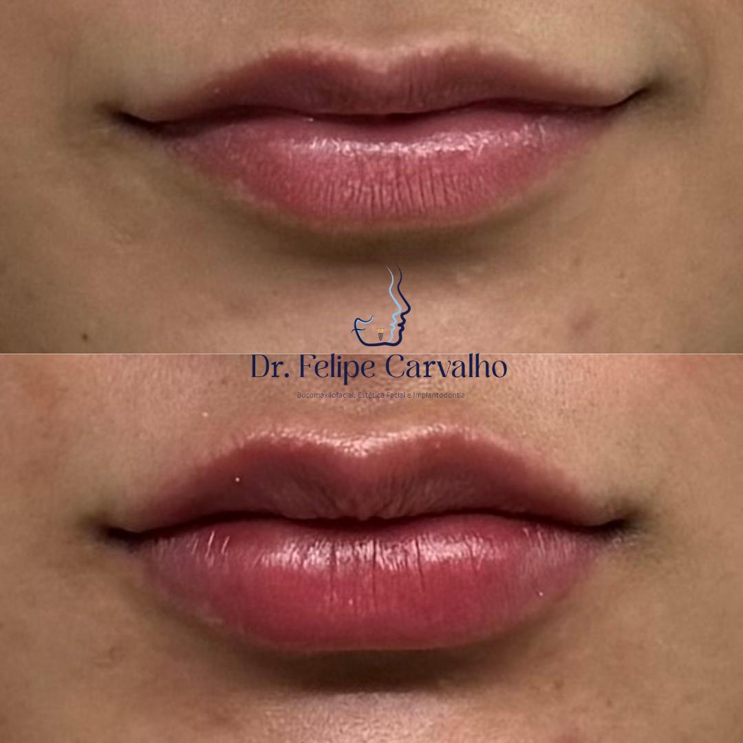 Caso real — Dr. Felipe Carvalho