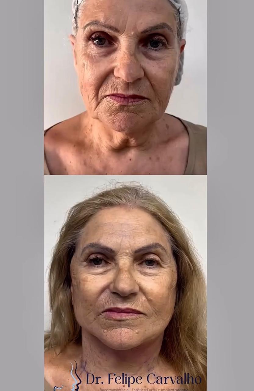 Caso real — Dr. Felipe Carvalho