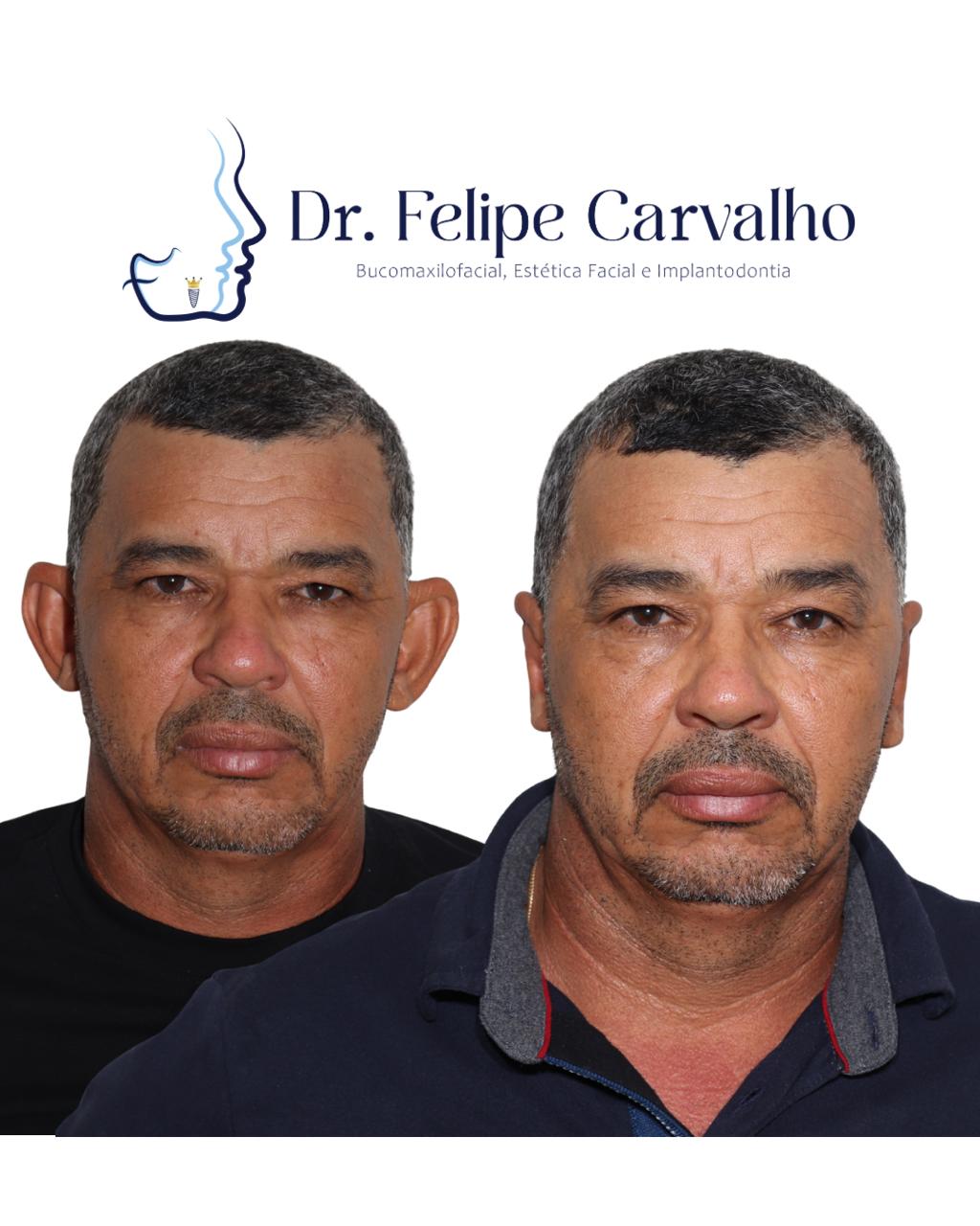 Caso real — Dr. Felipe Carvalho
