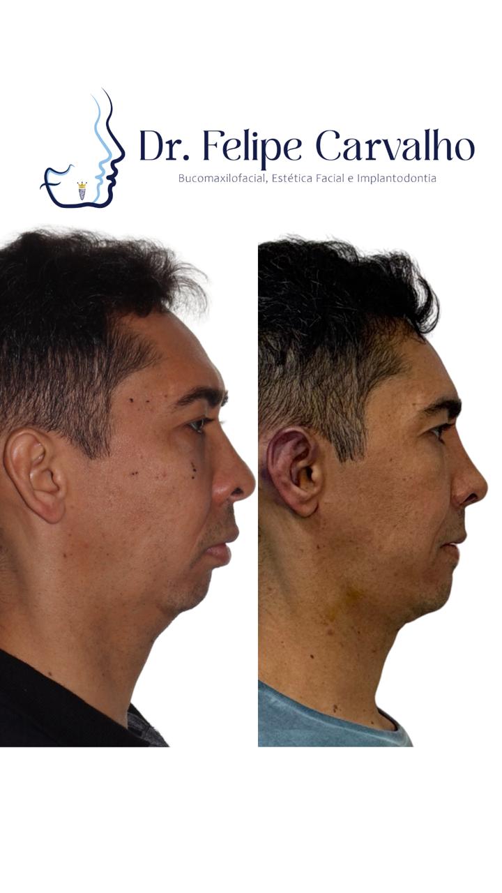 Caso real — Dr. Felipe Carvalho