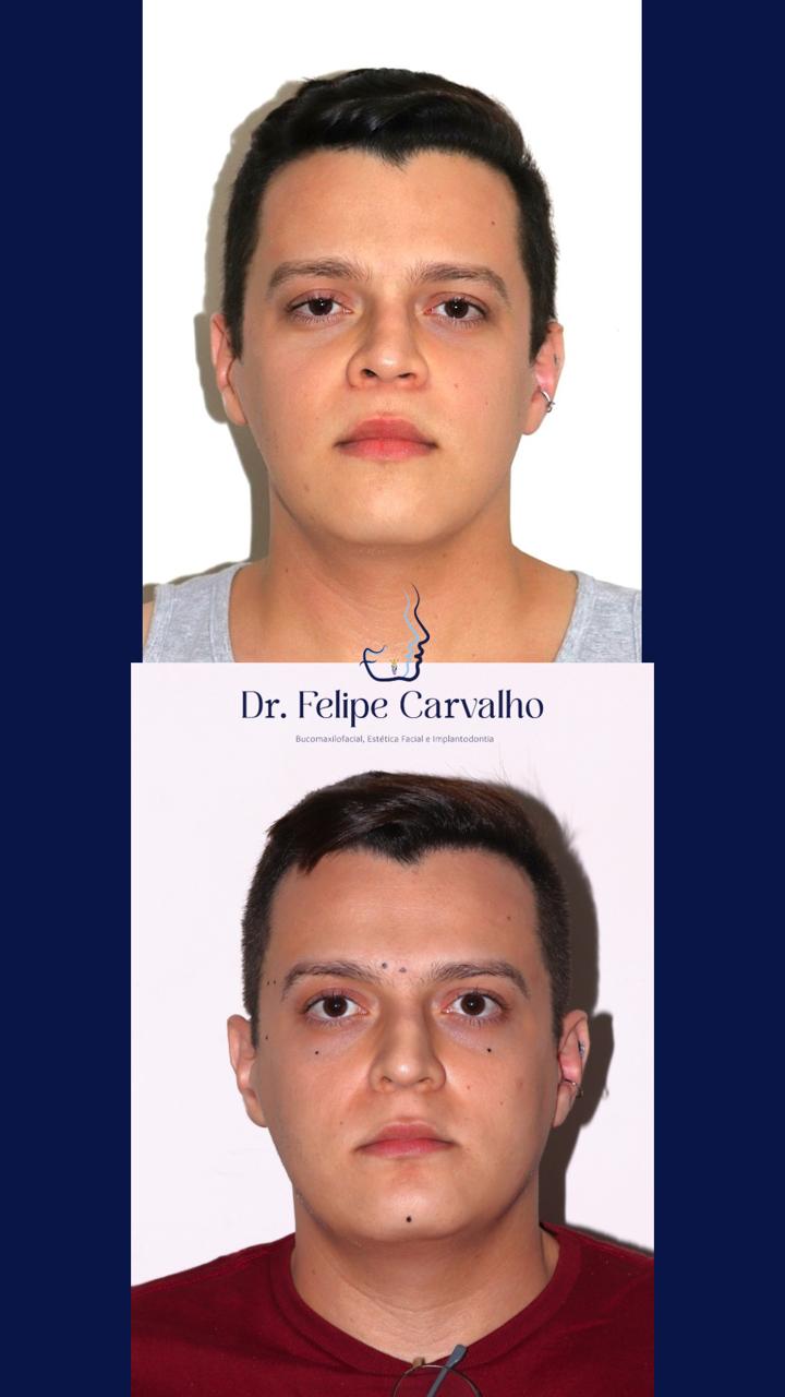 Caso real — Dr. Felipe Carvalho